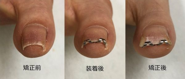 ネイル・エイドの症例：装着前・装着後・矯正後