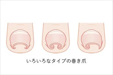 いろいろなタイプの巻き爪