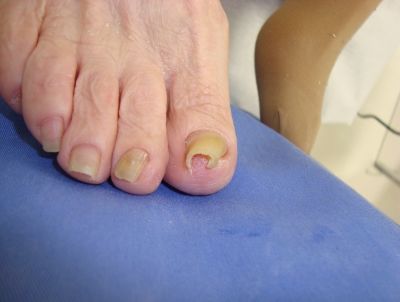 破損した巻き爪