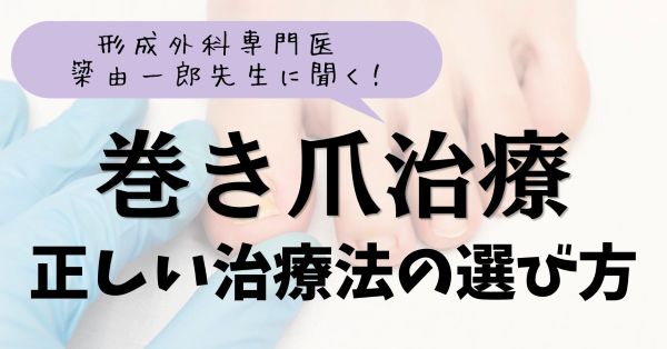 巻き爪治療の正解とは?形成外科専門医簗由一郎先生に聞く「正しい治療法の選び方」のアイキャッチ