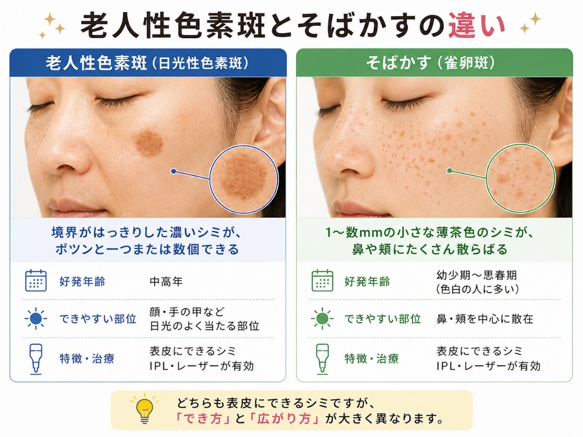老人性色素斑とソバカスの違い
