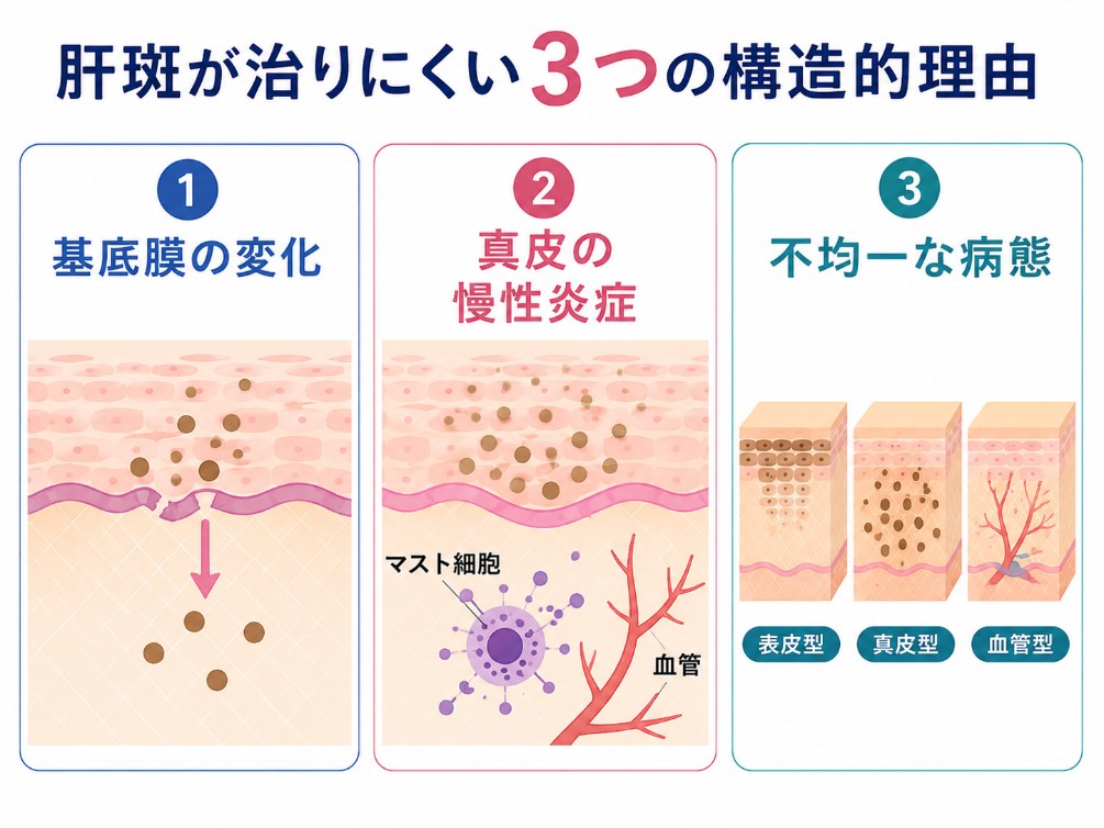 肝斑が治りにくい3つの理由の図