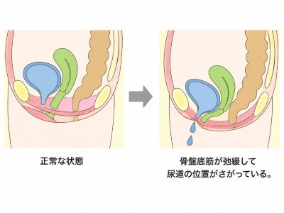 正常な尿道と位置が下がって尿失禁になりやすい状態