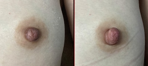 女性の症例ビフォーアフター(正面)