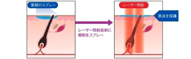 ジェントルマックスプロプラスのDCDシステム