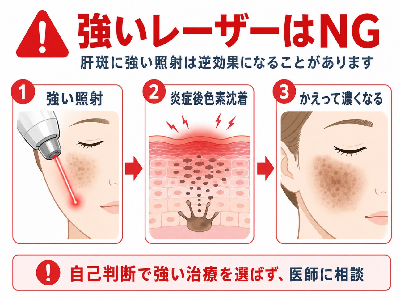 肝斑に強いレーザーがNGを示す図