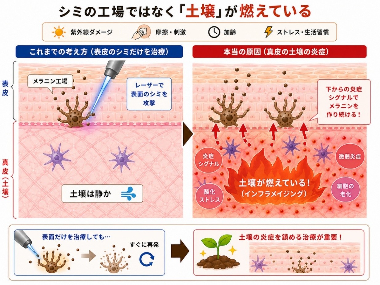 肝斑の病態を表すイラスト（インフラメイジングとの関係）