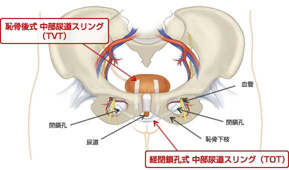日帰りTOT手術の仕組み