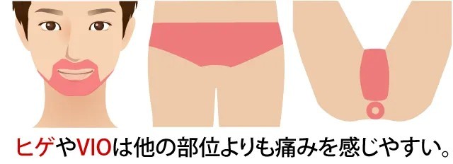 ヒゲやVIOの痛みのイメージ