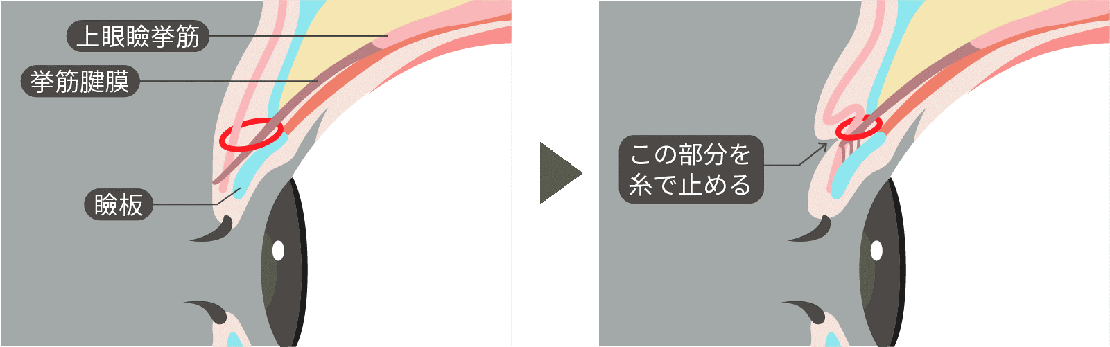 二重埋没法のイラスト