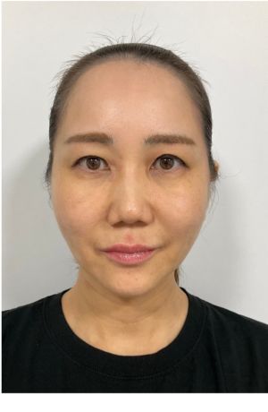 施術後の写真
