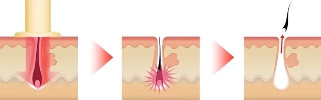 熱破壊式レーザーのメカニズム