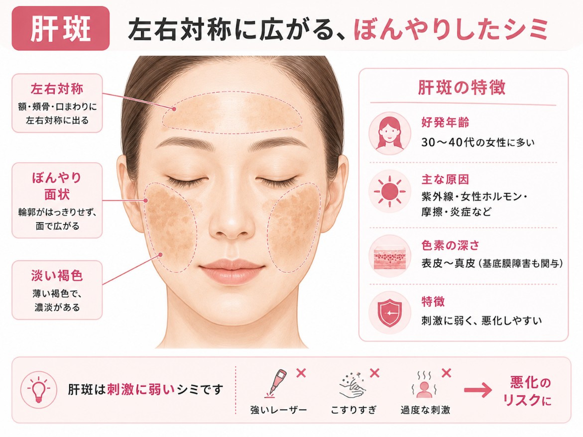 肝斑の特徴（左右対称・面状・境界不明瞭）