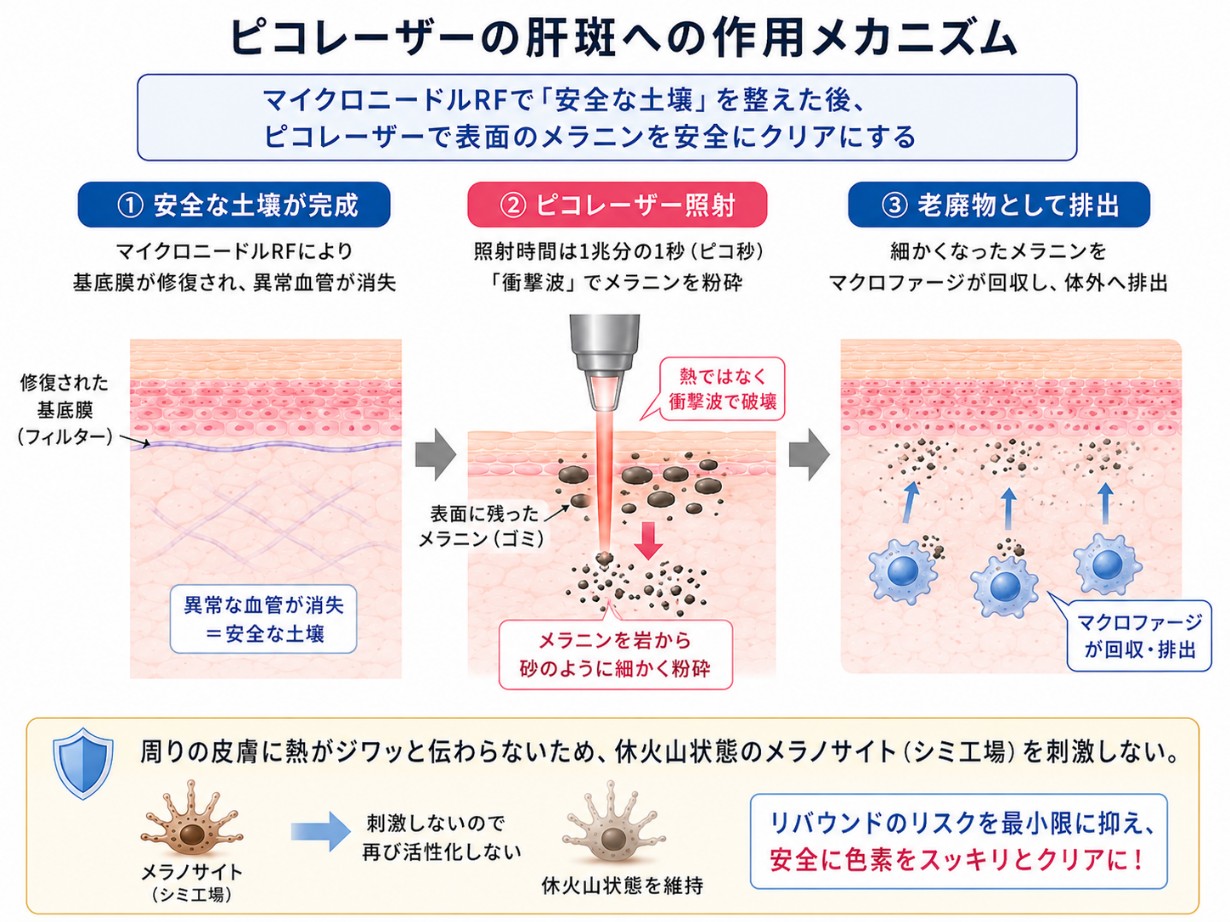 ピコレーザーの肝斑への効果のメカニズム
