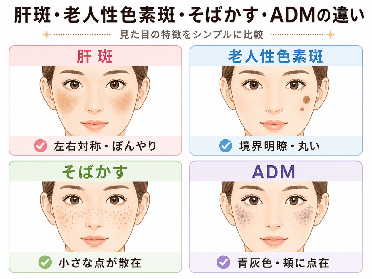 肝斑と他のシミの違い