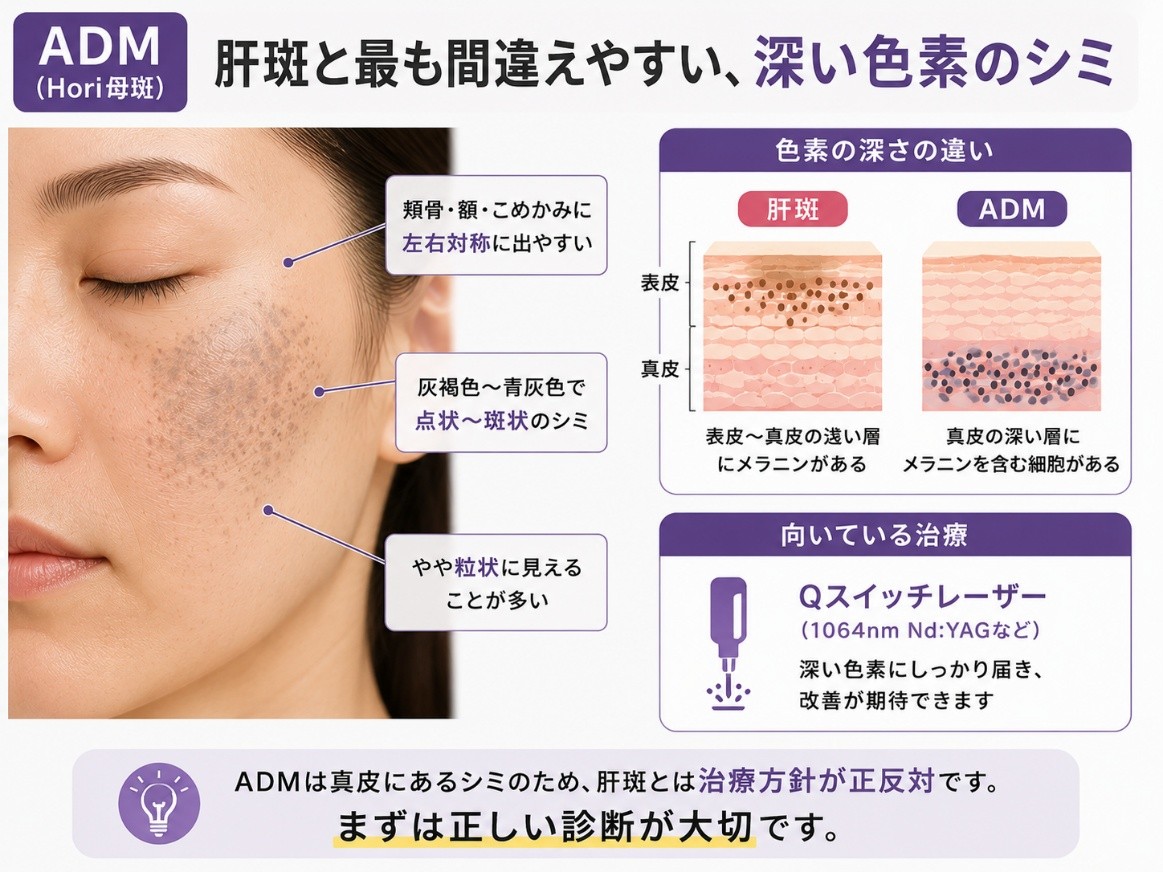 ADM（Hori母斑）の特徴（青灰色・点状〜斑状・真皮の色素）