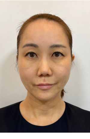 施術前の写真