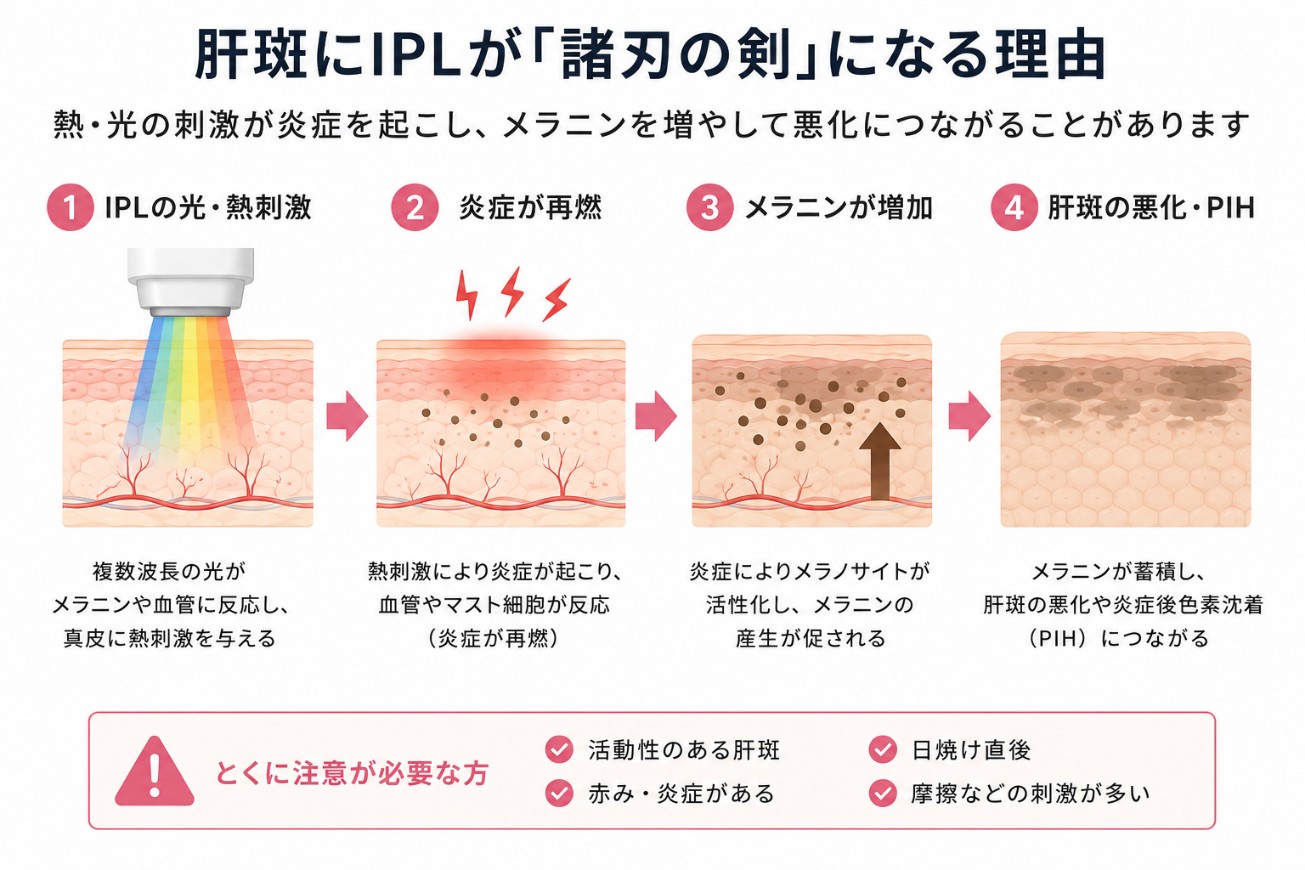 肝斑にIPLが悪化リスクとなる理由（熱・光と炎症）