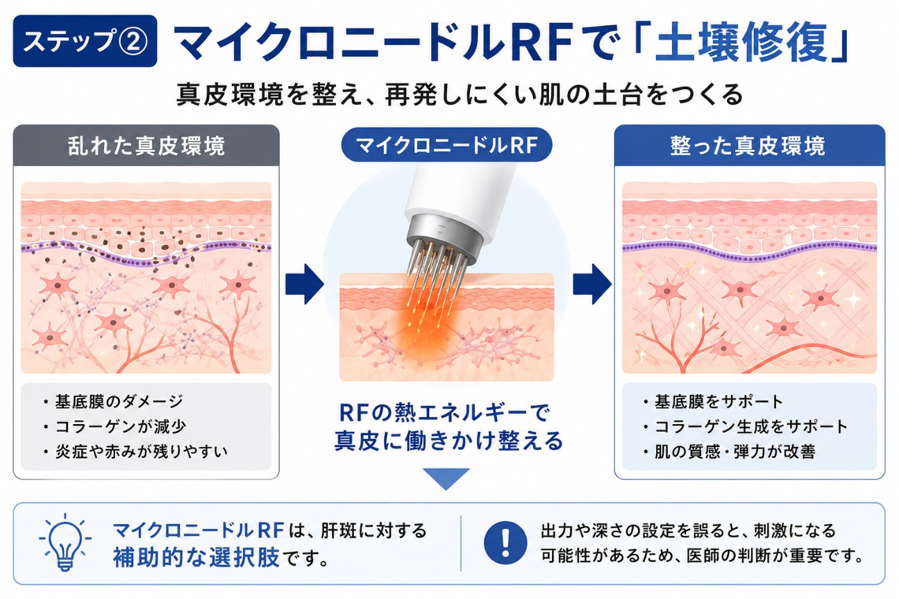 ステップ②マイクロニードルRFで「土壌修復」の図