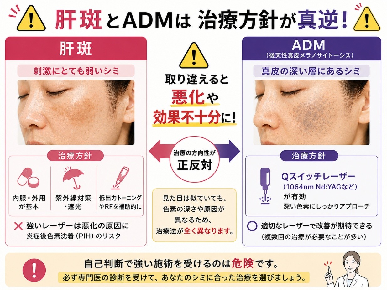 肝斑とADMの治療方針の違い