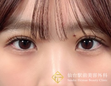 匠式二重埋没法の症例アフター