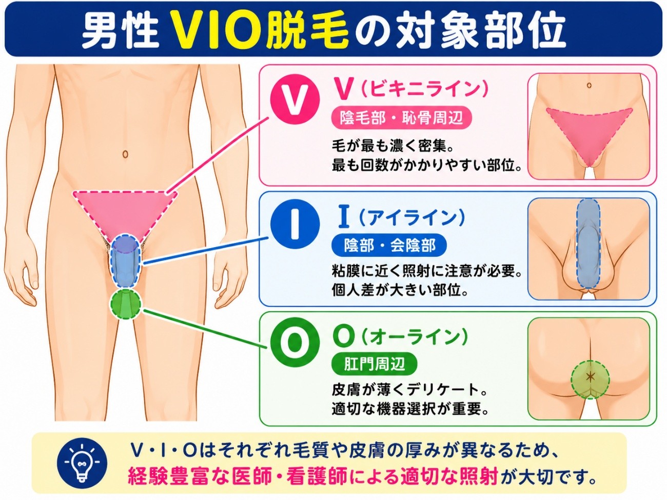  VIO脱毛の対象部位の図解