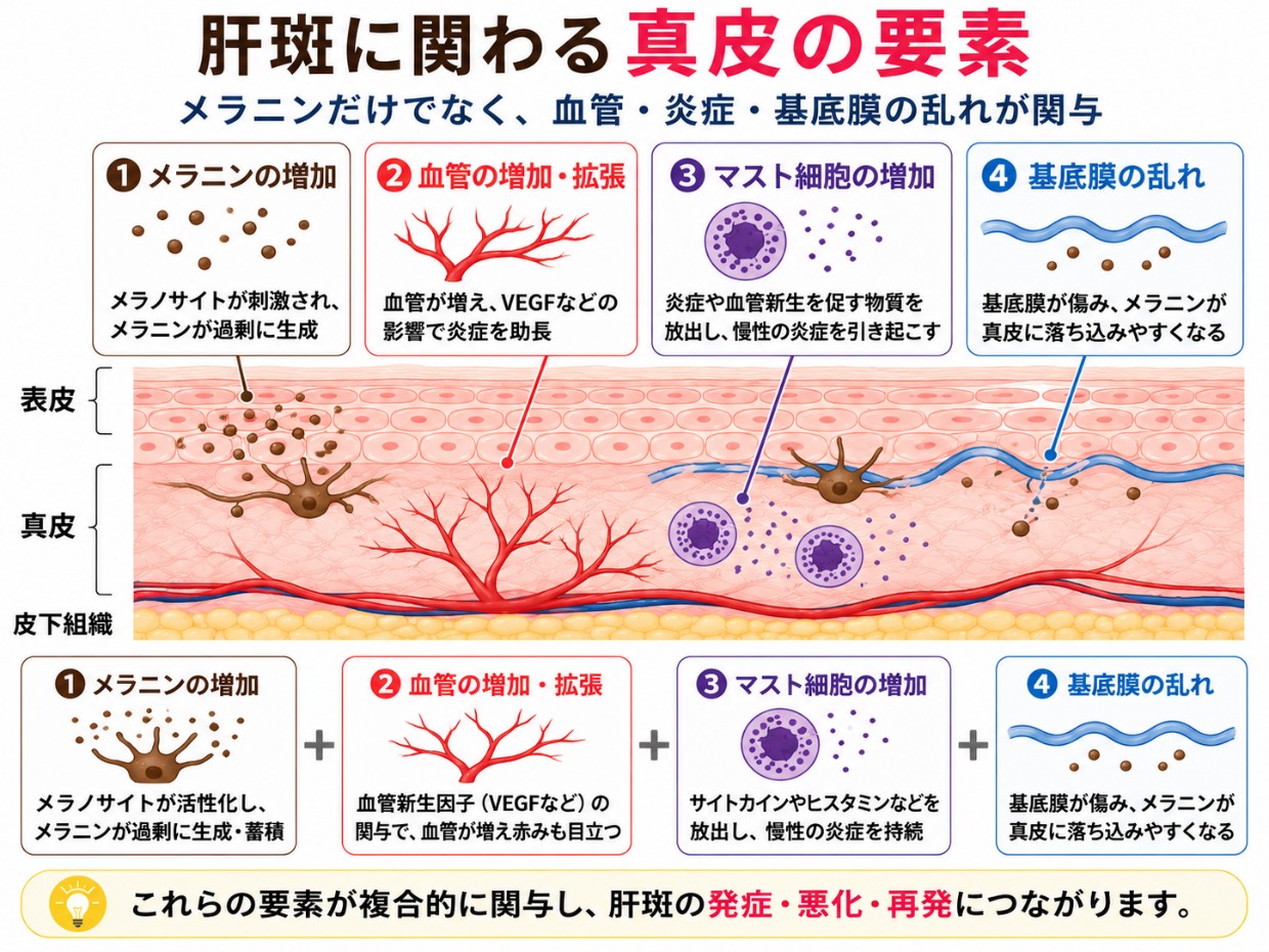 肝斑に関わる真皮の要素（血管・マスト細胞・基底膜）