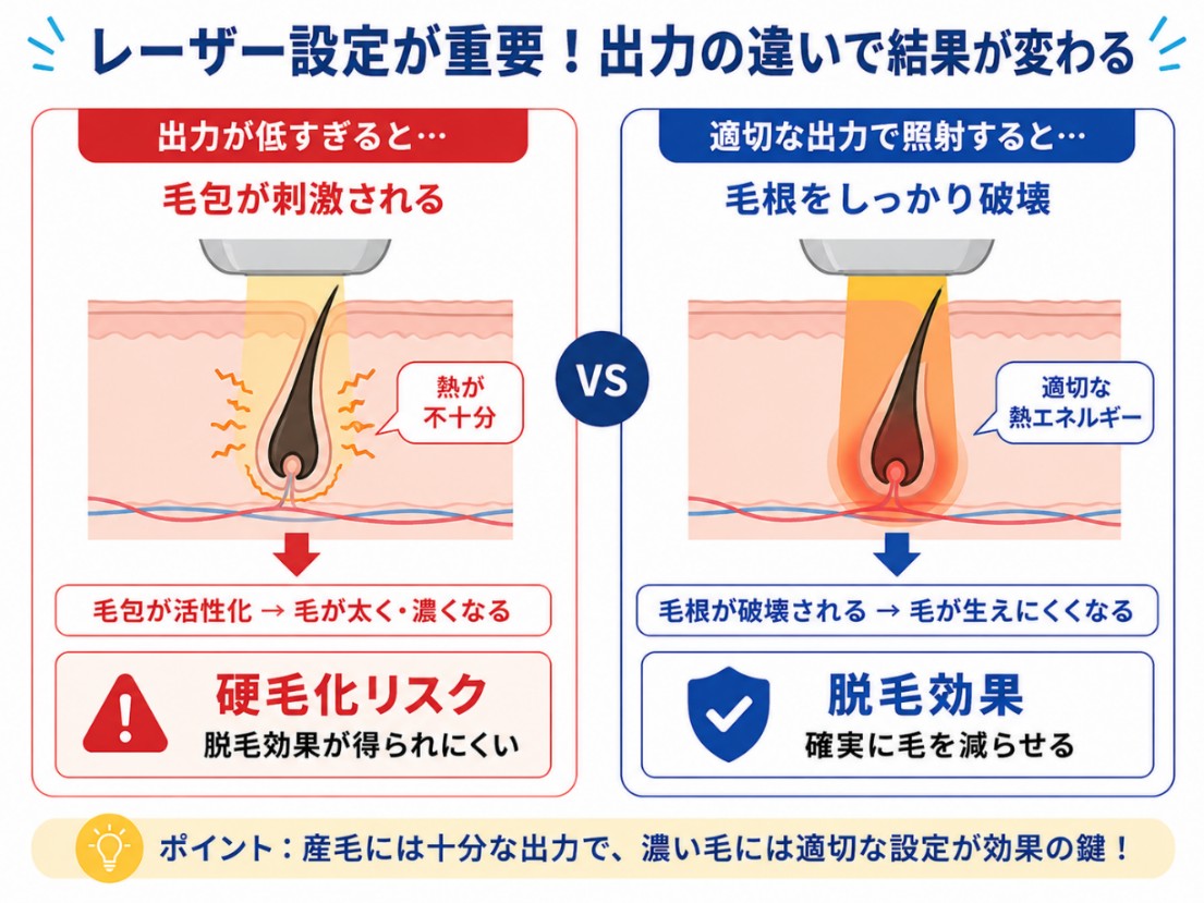 硬毛化を防ぐレーザー脱毛の出力設定を示す図