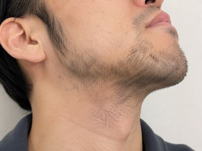 硬毛化・増毛化した男性の写真