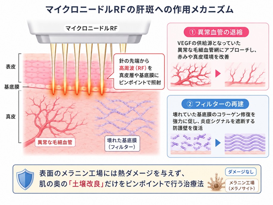 マイクロニードRFの肝斑への効果のメカニズム