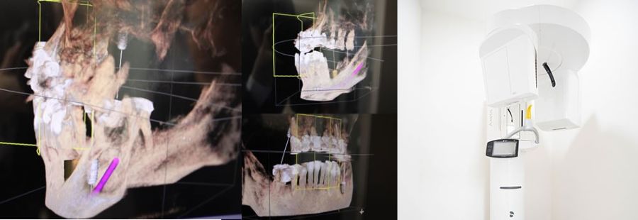 歯科用CT