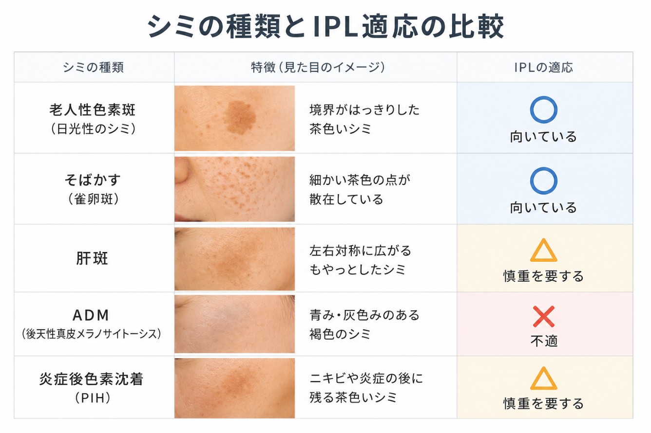 肝斑と老人性色素斑などの見分けとIPL適応