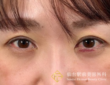 二重埋没法抜糸の症例アフター