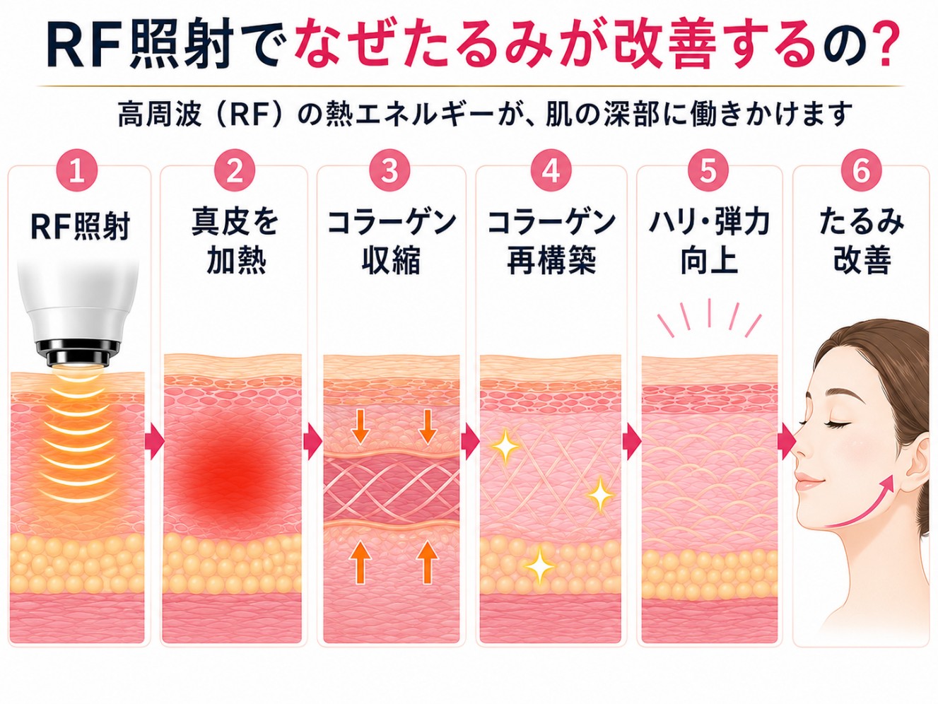 高周波治療のメカニズム