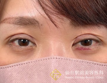 二重埋没法抜糸の症例ビフォー