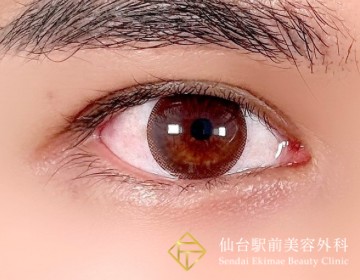 二重切開法の症例アフター
