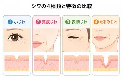 しわの種類（小じわ・真皮じわ・表情じわ・たるみじわ）の比較図