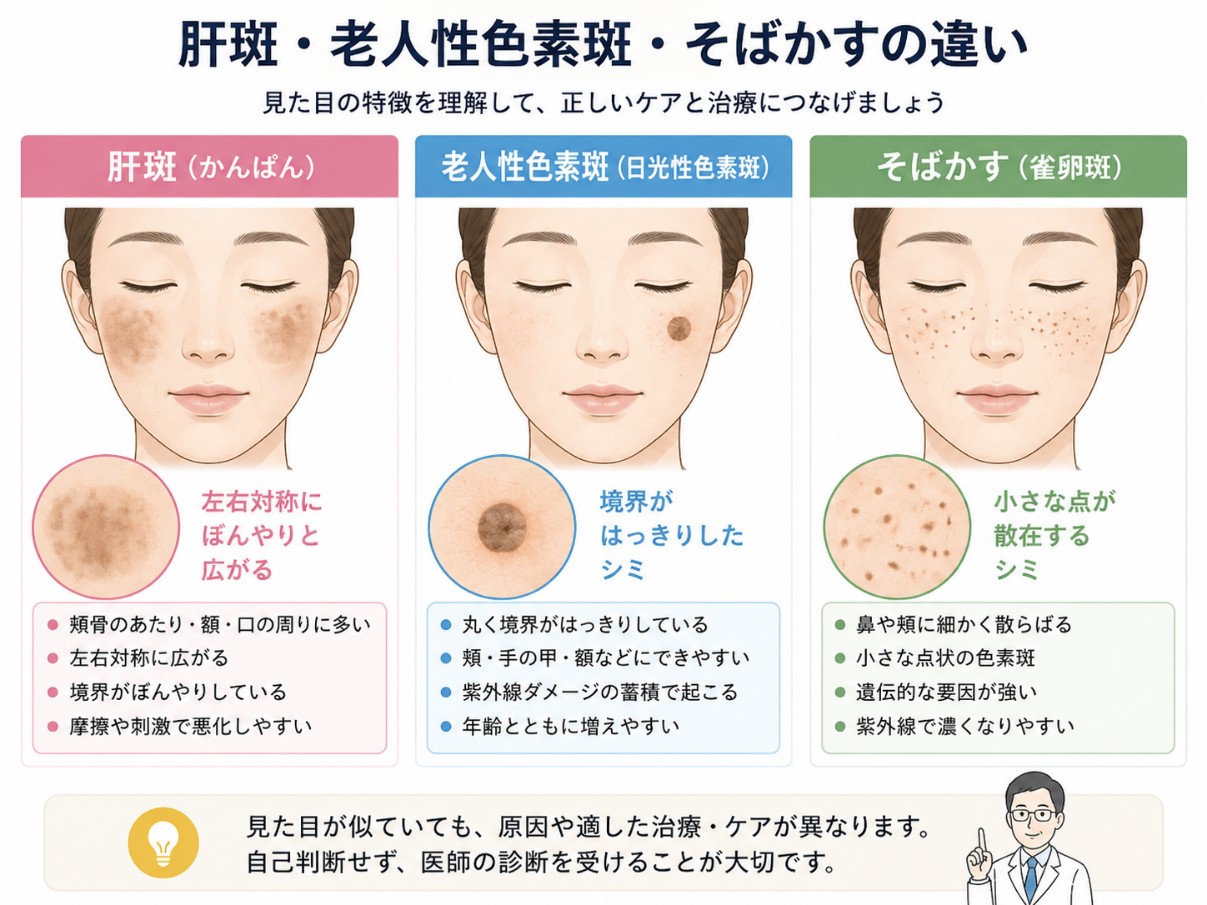 肝斑と老人性色素斑・そばかすの違い