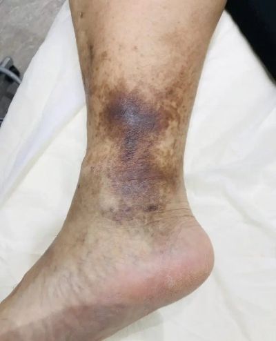 うっ滞性皮膚炎による皮膚の黒ずみの写真