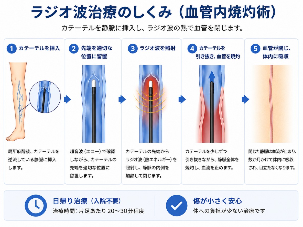 ラジオ波治療のしくみ