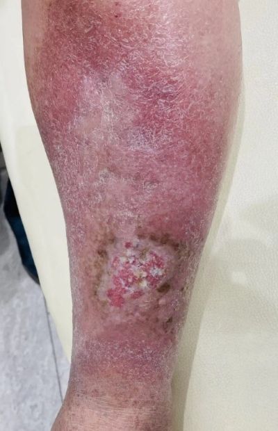 うっ滞性皮膚炎による皮膚潰瘍の写真
