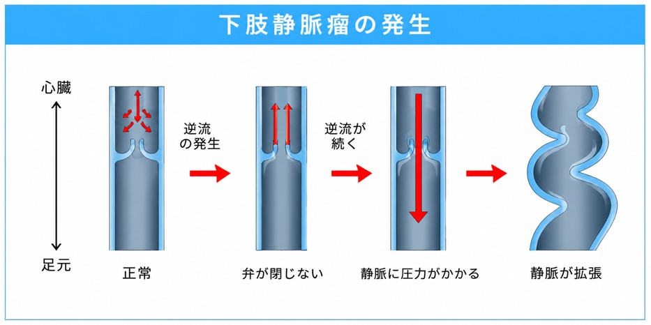 下肢静脈瘤の発生のメカニズム