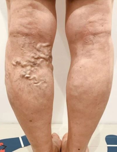 脚の血管がこぶ状に浮き出た下肢静脈瘤の写真