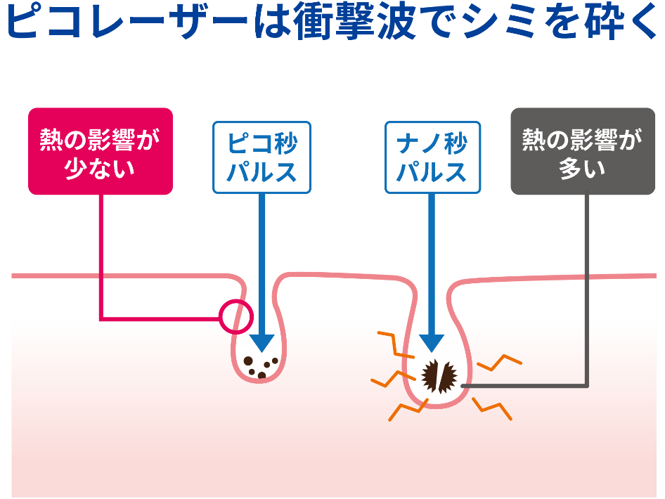 ピコレーザーの衝撃波の仕組みを示すイラスト