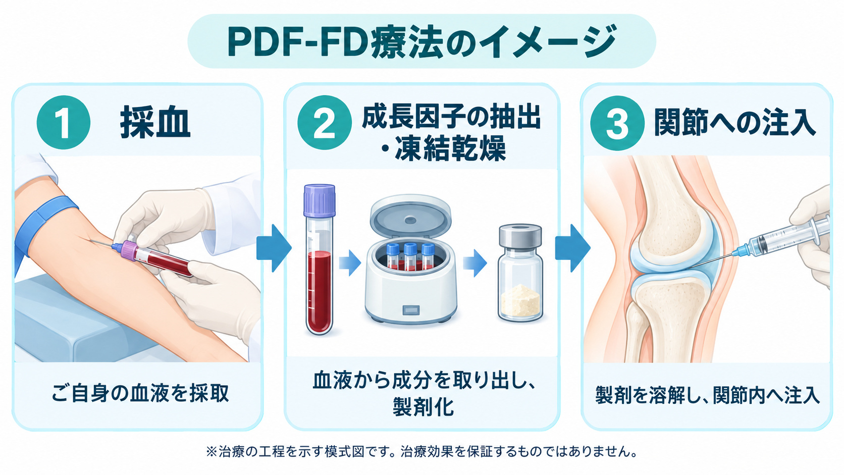 採血、成長因子の抽出・凍結乾燥、関節への注入というPDF-FD療法の3ステップを示す模式図