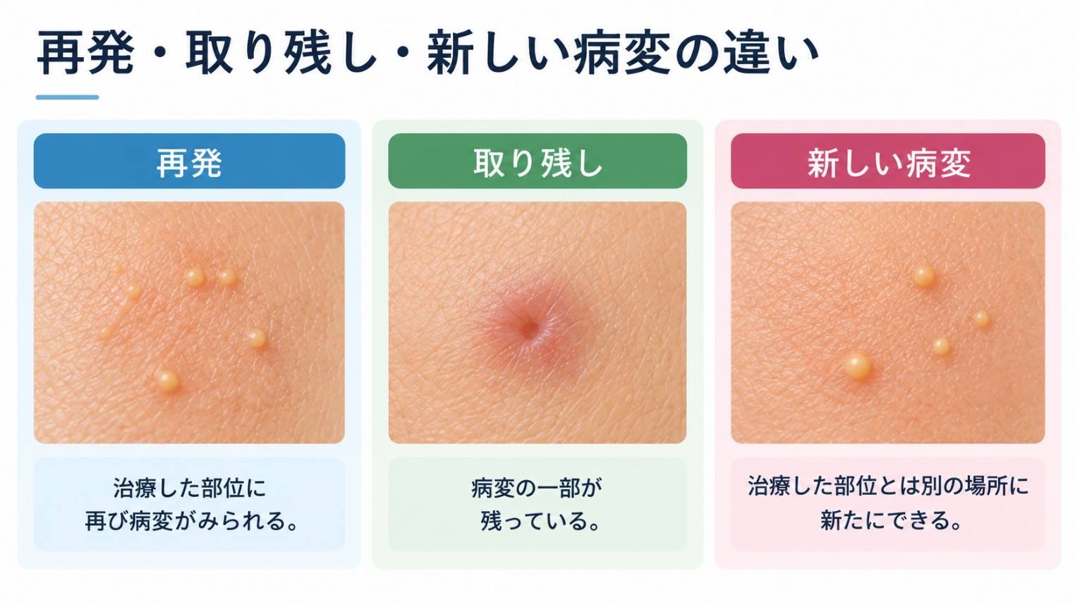 脂腺増殖症治療後の再発、取り残し、治療部位とは別の場所にできる新しい病変の違いを示す図