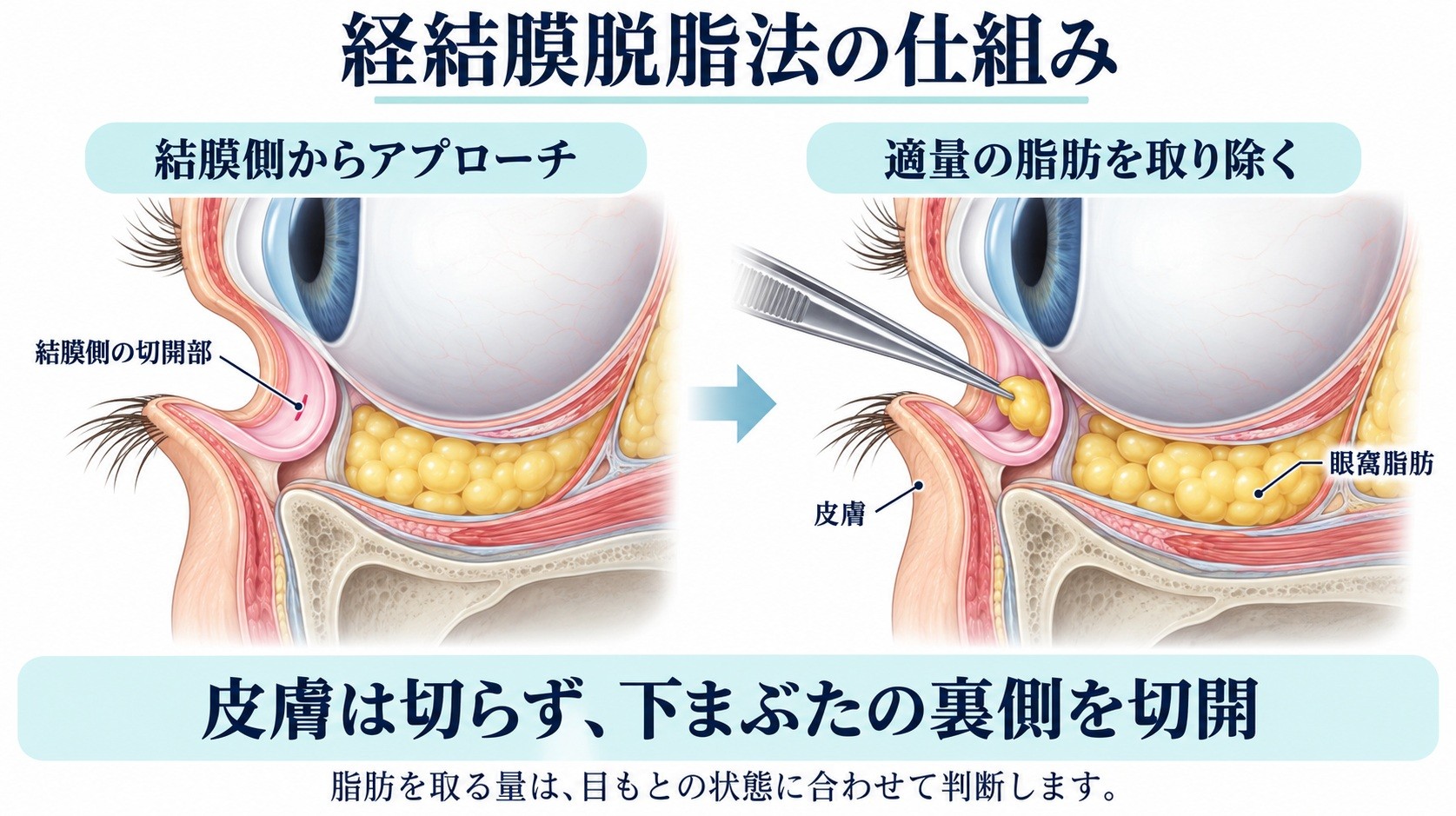皮膚を切らず、下まぶたの裏側（結膜側）を切開して適量の眼窩脂肪を取り除く経結膜脱脂法の仕組み図