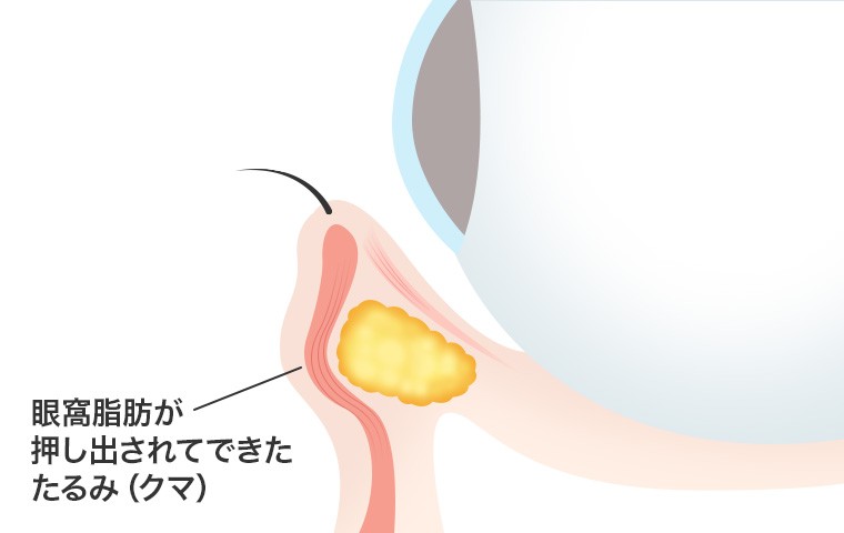 下まぶたの眼窩脂肪が前に押し出されてできる目の下のふくらみ（クマ）を示す断面図