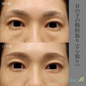 AILE clinicの目の下の脂肪取り（クマ取り）の症例1（施術前・1か月後）