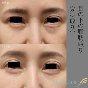 AILE clinicの目の下の脂肪取り（クマ取り）の症例2（施術前・3か月後）
